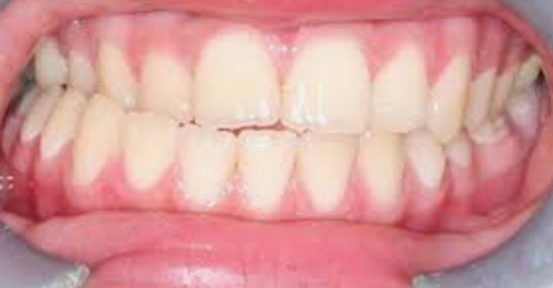 teeth grinding back molars
