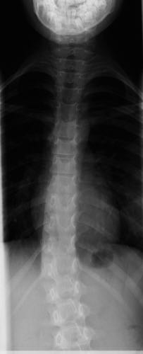 scoliosis before treatment