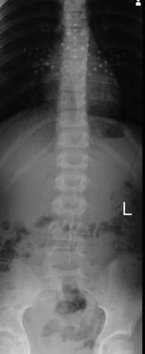 scoliosis after treatment