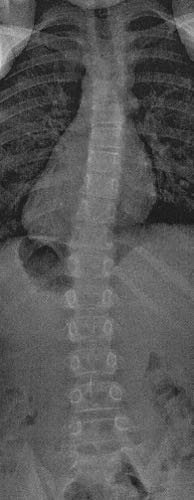 scoliosis after treatment
