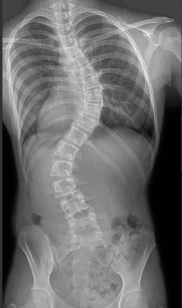 Scoliosis